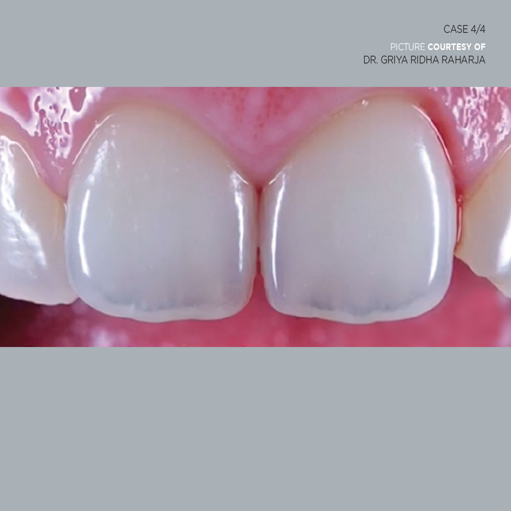 Air abrasion cleaning case after image - Optident