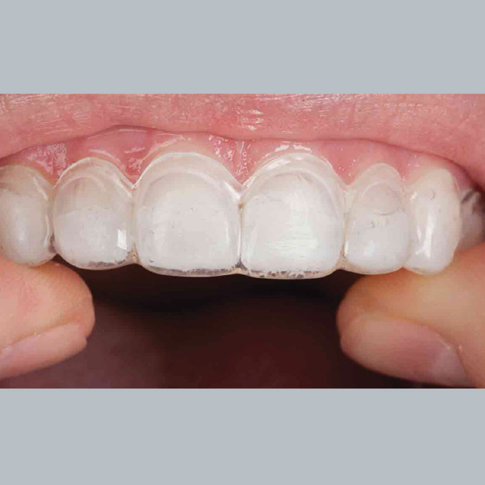Tooth Whitening Trays in Place